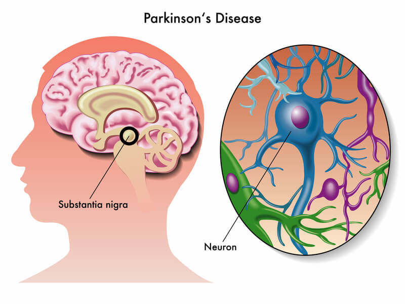 Болезнь Паркинсона: симптомы и признаки | Как вылечить ее навсегда