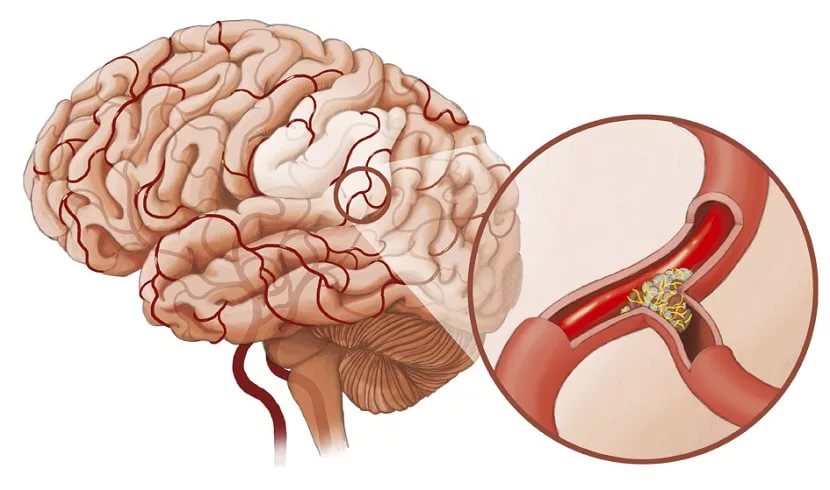 Атеросклероз артерий головного мозга