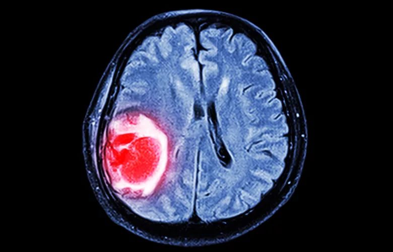 Можно ли полностью вылечить метастазы в головной мозг?