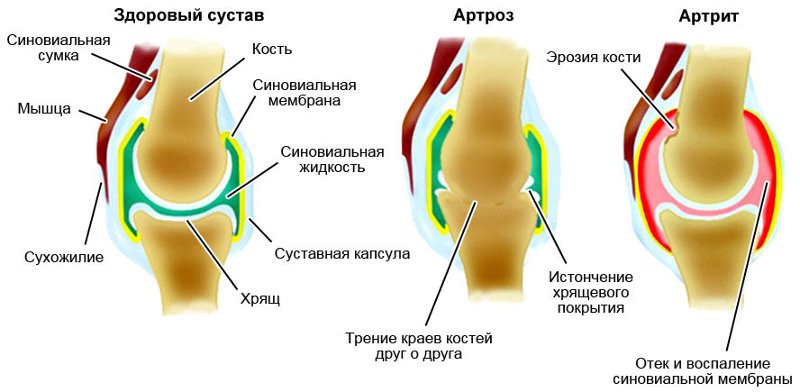 lasersko liječenje zgloba koljena s artrozom